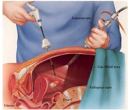 لاپاراسکوپی آندومتریوز