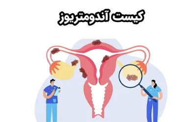 راهنمای جامع کیست آندومتریوز