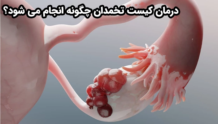درمان کیست تخمدان به نوع، اندازه و علائم ایجاد شده بستگی دارد.