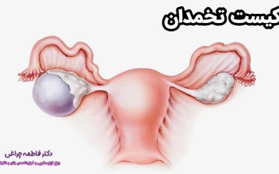 هرآنچه باید درباره کیست تخمدان بدانید!