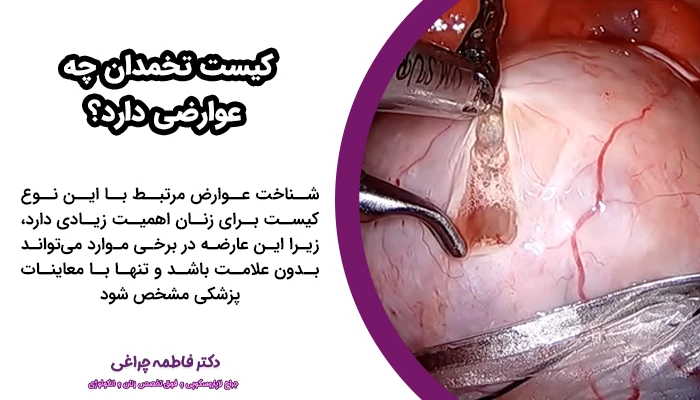 چهار عارضه کیست تخمدان شامل: پارگی کیست (Rupture)، پیچش تخمدان،(Ovarian Torsion) و احتمال نادر بدخیمی است