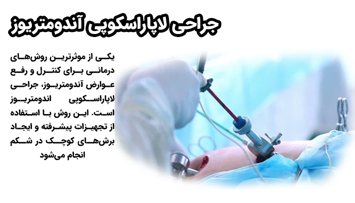 لاپاراسکوپی آندومتریوز یک روش کم‌تهاجمی است که برای تشخیص و درمان مشکلات ناشی از آندومتریوز به کار می‌رود.