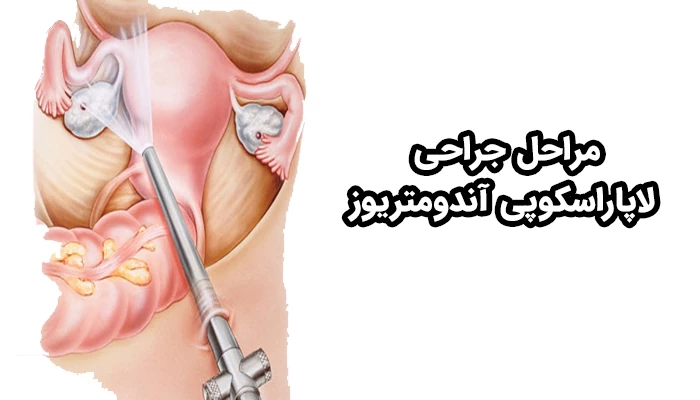 جراحی آندومتریوز با لاپاراسکوپی طی چند مرحله از آماده سازی بیمار تا دوران نقاهت بعد از عمل انجام می‌شود.