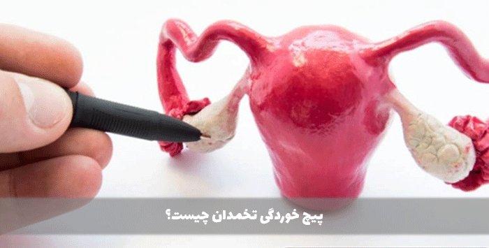 پیچ خوردگی تخمدان چیست؟