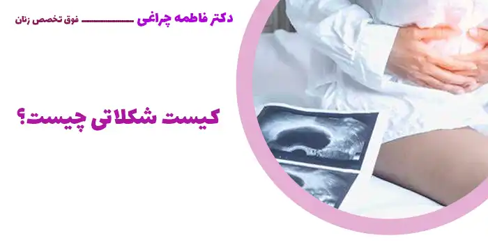 کیست شکلاتی چیست؟