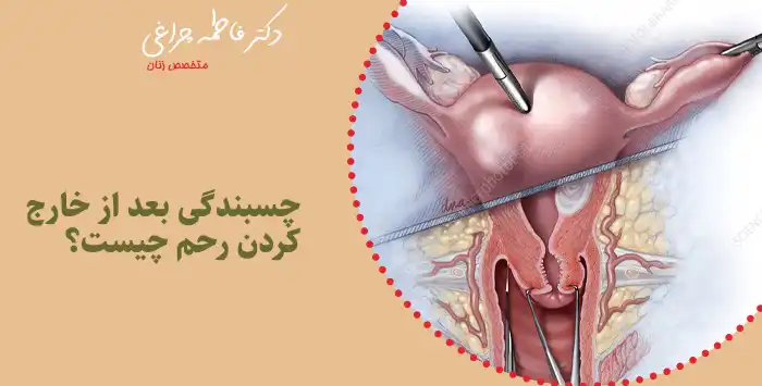 چسبندگی بعد از خارج کردن رحم
