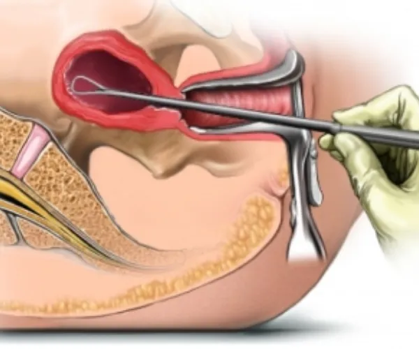 تفاوت کورتاژ با هیستروسکوپی