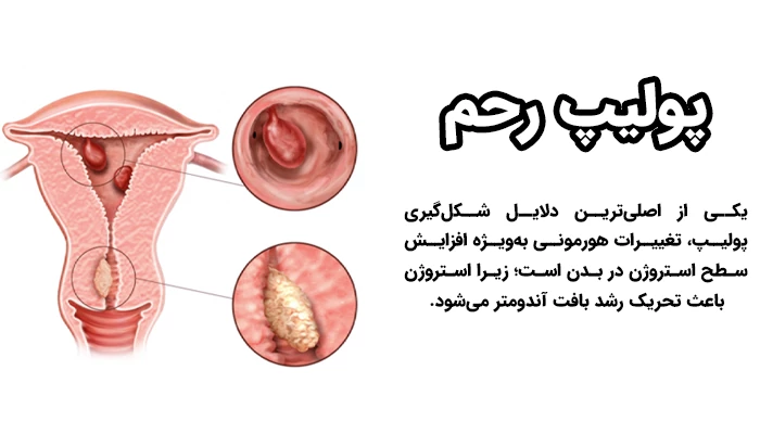 پولیپ‌ رحم توده‌ است که به دیواره داخلی رحم چسبیده‌ و می تواند در مواردی خطرناک باشد.