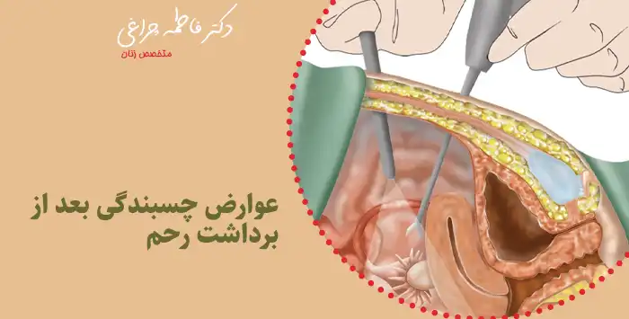 عوارض چسبندگی بعد از برداشت رحم