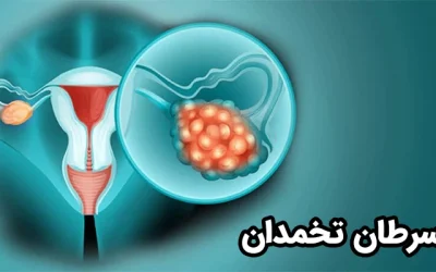بررسی 0 تا 100 سرطان تخمدان