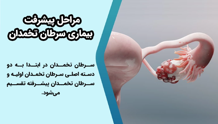 سرطان تخمدان به چهار مرحله و براساس میزان گسترش تومور در بدن تقسیم بندی می شود