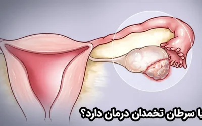 آیا سرطان تخمدان درمان دارد؟ | درمان قطعی سرطان تخمدان