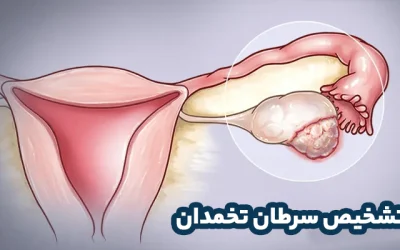 سرطان تخمدان چگونه تشخیص داده می شود؟
