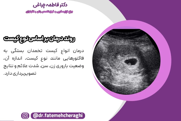 روند درمان کیست تخمدان به نوع، اندازه، علائم و سن بیمار بستگی دارد
