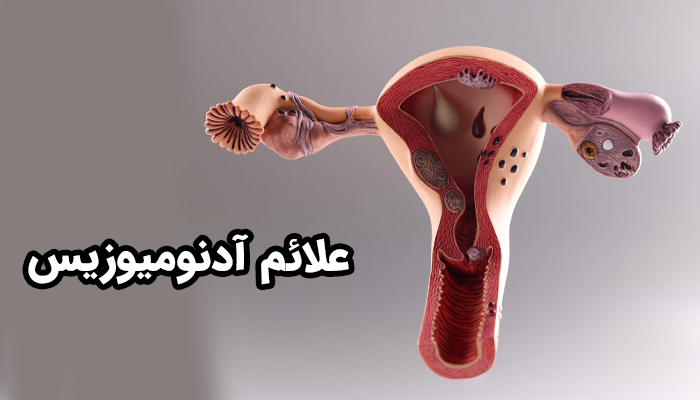 علائم آدنومیوزیس می‌تواند از نوع خفیف و گاه بدون نشانه تا نوع شدید و مخرب متغیر باشد.