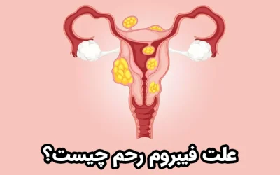 چرا فیبروم رحم ایجاد می‌شود؟