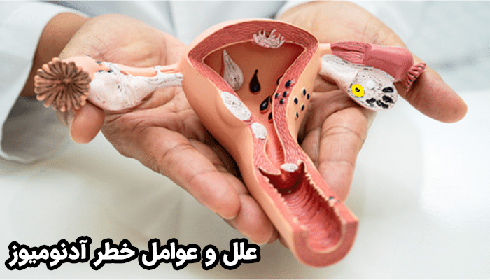 علت دقیق آدنومیوزیس هنوز به طور کامل مشخص نیست.