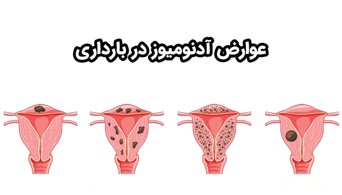 از عوارض بارداری با آدنومیوز، می‌توان به سقط جنین و زایمان زودرس اشاره کرد