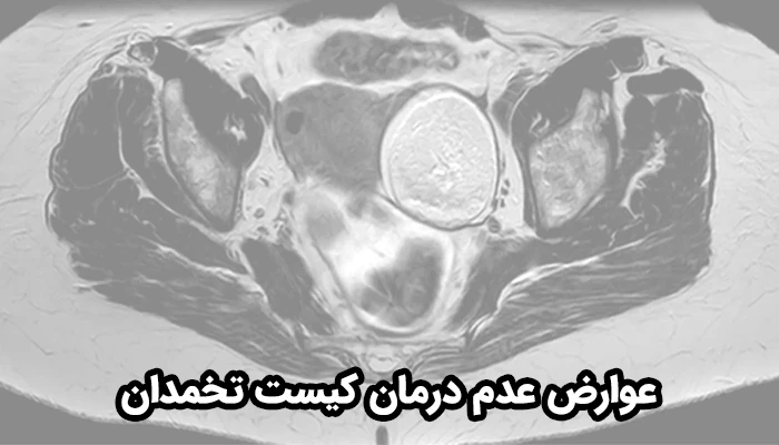 اگر درمان کیست تخمدان به‌موقع انجام نشود، ممکن است بیمار با مجموعه‌ای از عوارض جدی و گاه غیرقابل‌برگشت مواجه شود.