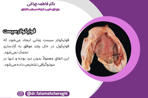 عکس کیست تخمدانی فولیکولار