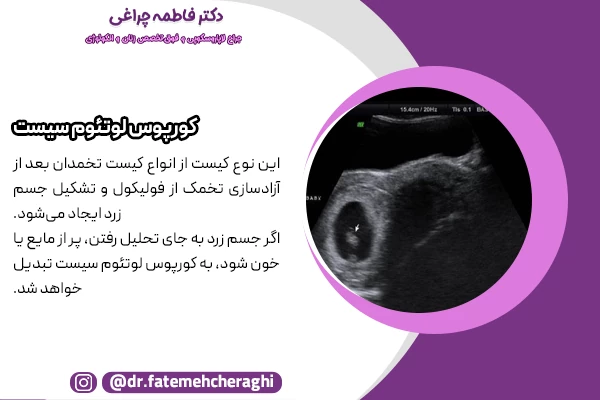 عکس کیست تخمدان کورپوس لوتئوم سیست