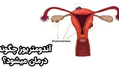 آندومتریوز چگونه درمان میشود؟ | بهترین درمان اندومتریوز