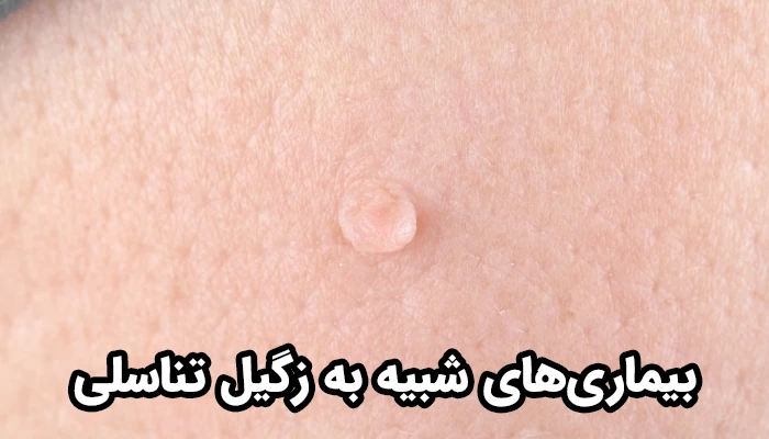 در بسیاری از مواقع، افراد زائده‌های پوستی اطراف ناحیه تناسلی را با زگیل تناسلی اشتباه می‌گیرند.