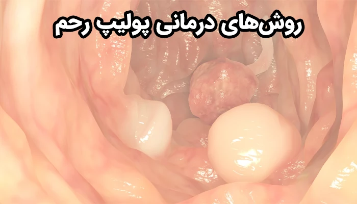 درمان پولیپ رحم به سه دسته دارودرمانی، جراحی و مکمل تقسیم می‌شود