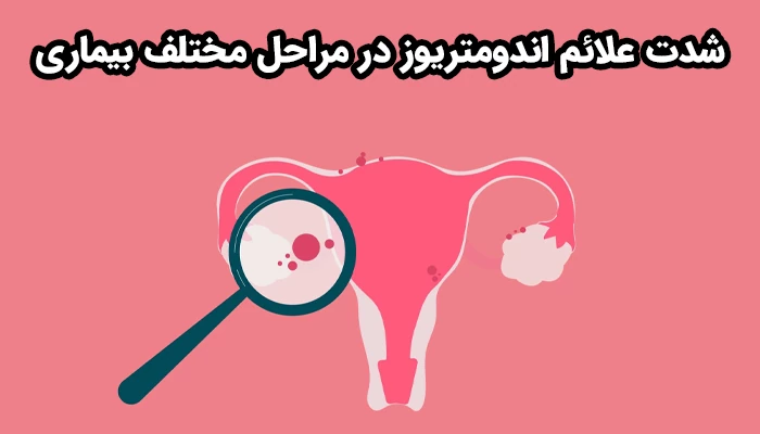 شدت نشانه های اندومتریوز در مراحل مختلف بیماری متفاوت است.