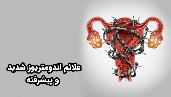 علائم آندومتریوز در مراحل پیشرفته به طور قابل توجهی افزایش می‌یابند.