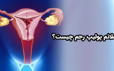 علائم پولیپ رحم چیست؟