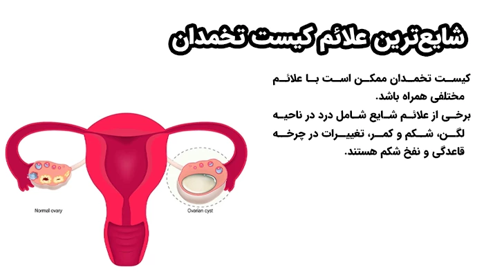 کیست تخمدان ممکن است با علائم مختلفی همراه باشد. برخی از علائم شایع شامل درد در ناحیه لگن، شکم و کمر، تغییرات در چرخه قاعدگی و نفخ شکم هستند.