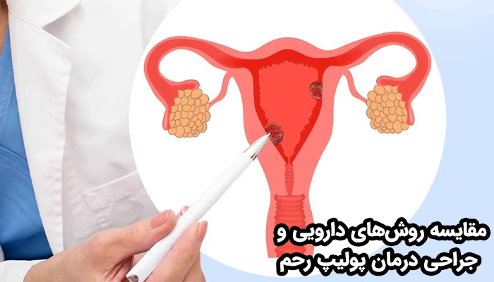 هر کدام از روش‌های دارویی و جراحی در درمان پولیپ رحم، مزایا و معایب خاص خود را دارند.