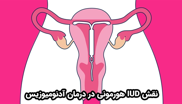 دستگاه داخل رحمی لوونورژسترل (Mirena) یک روش بسیار مؤثر در درمان غیرجراحی آدنومیوز است.