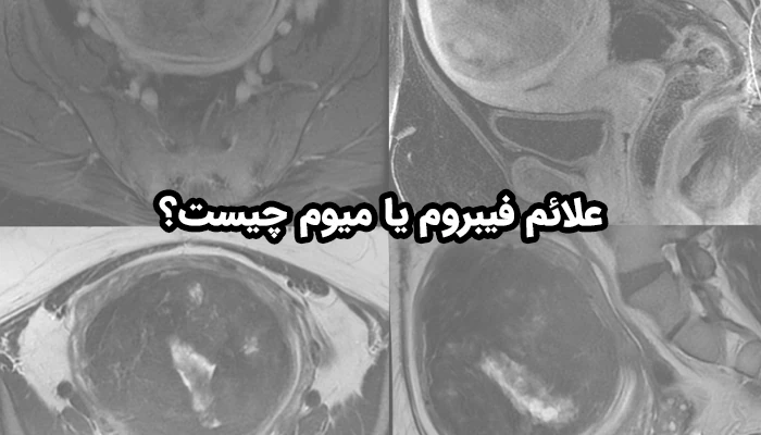 اصلی ترین علائم فیبروم رحم، شامل خونریزی شدید و طولانی‌مدت قاعدگی است که می‌تواند به کم‌خونی منجر شود.