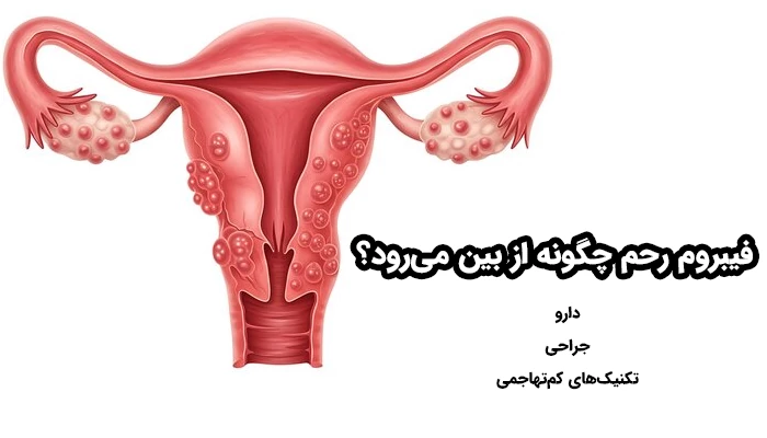 روش‌ های اصلی درمان فیبروم شامل دارو، جراحی و تکنیک‌های کم‌تهاجمی هستند.