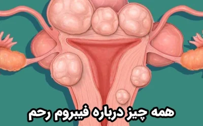 همه چیز درباره فیبروم رحم