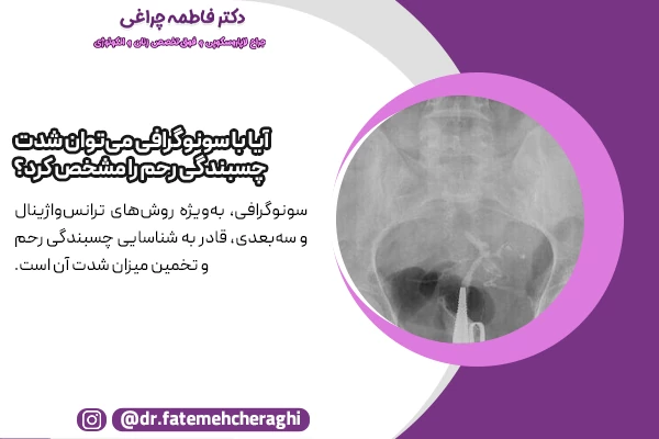 سونوگرافی به‌ روش‌های ترانس‌واژینال و سه‌بعدی، قادر به شناسایی چسبندگی رحم و تخمین میزان شدت آن است
