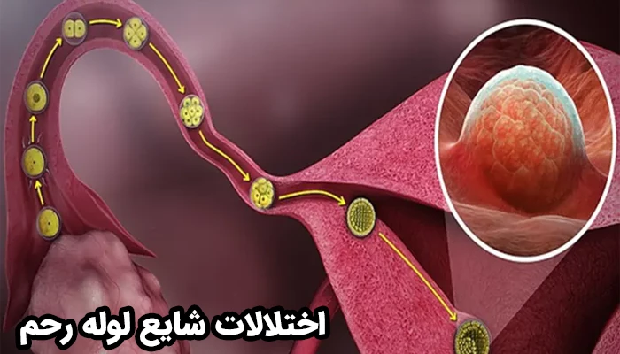 انسداد لوله‌های رحم، چسبندگی و التهاب و ضایعات ناشی از عفونت یا اندومتریوز سه اختلال شایع لوله رحم محسوب می‌شود