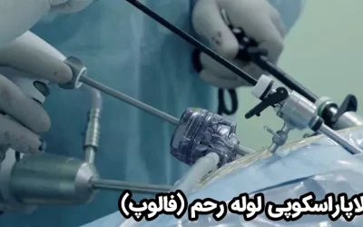 هرآنچه باید درباره لاپاراسکوپی لوله فالوپ بدانید؛ روش تشخیص و درمان ناباروری