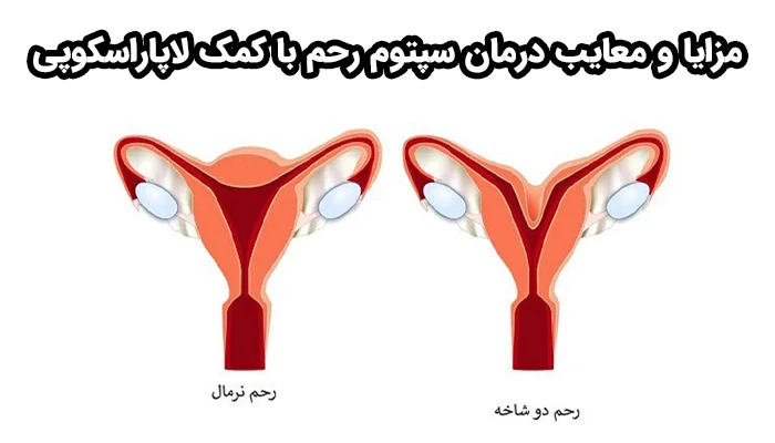 لاپاراسکوپی سپتوم رحم، دقت عمل سپتوم را بالا برده و ریسک عوارض را کاهش میدهد.