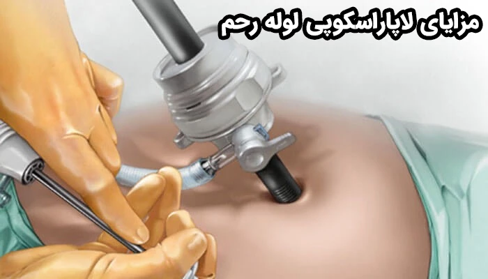 لاپاراسکوپی لوله رحم با حداقل آسیب بافتی، دقت بالا و بازگشت سریع به فعالیت روزمره همراه است.
