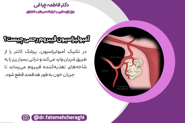 در آمبولیزاسیون، پزشک کاتتر را از طریق شریان وارد می‌کند و ذراتی بسیار ریز را به شاخه‌های تغذیه‌کننده فیبروم می‌رساند تا جریان خون به‌طور هدفمند قطع شود.
