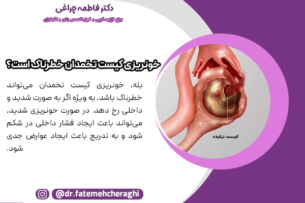 خونریزی بعد از ترکیدن کیست تخمدان