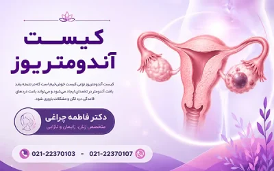 راهنمای جامع کیست آندومتریوز